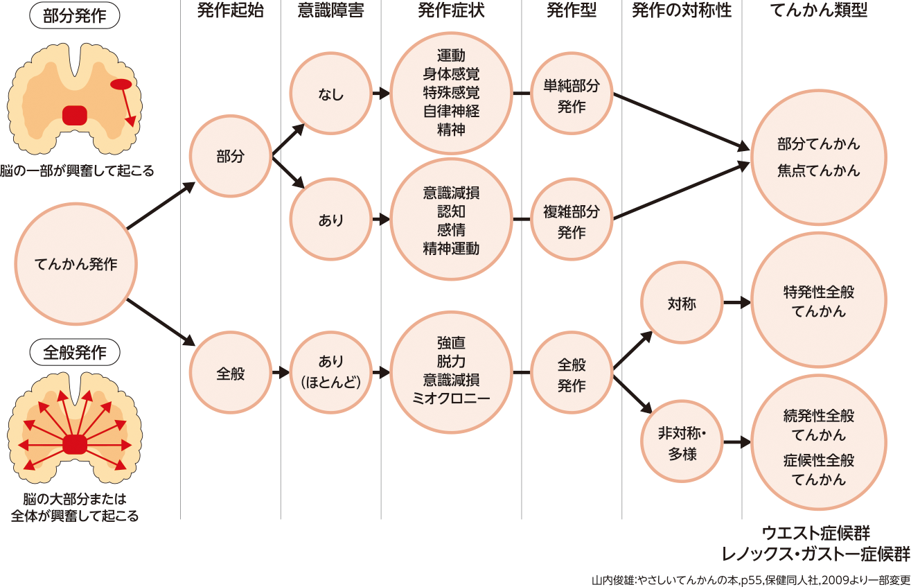 てんかんについて てんかんとは てんかんinfo